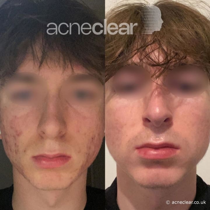 acneclear - patient image